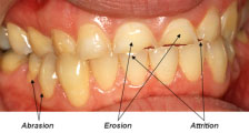 tooth_wear