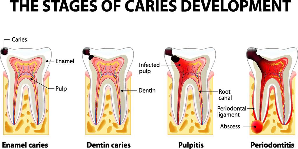 Dental Caries