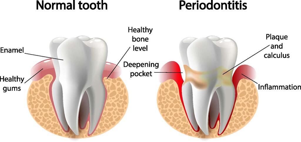 stress periodontal disease