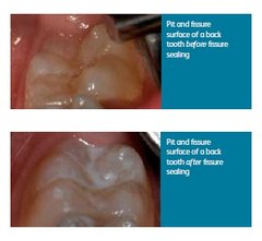 dental caries tooth decay dental health foundation