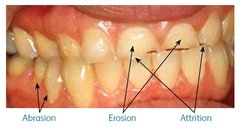 Prednisone 10mg used for | Can prednisone cause diarrhea ...